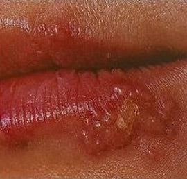 DERMA KURE CREAM