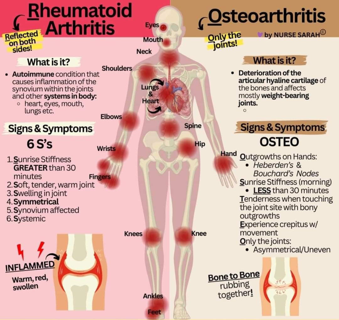 Arthritis